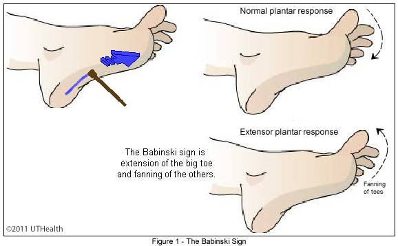 The Babinski Sign