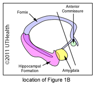 Coronal to Posterior Commissure Fornix