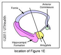 Diencephalon at Mammillary Bodies