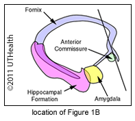 Coronal to Anterior Commissure